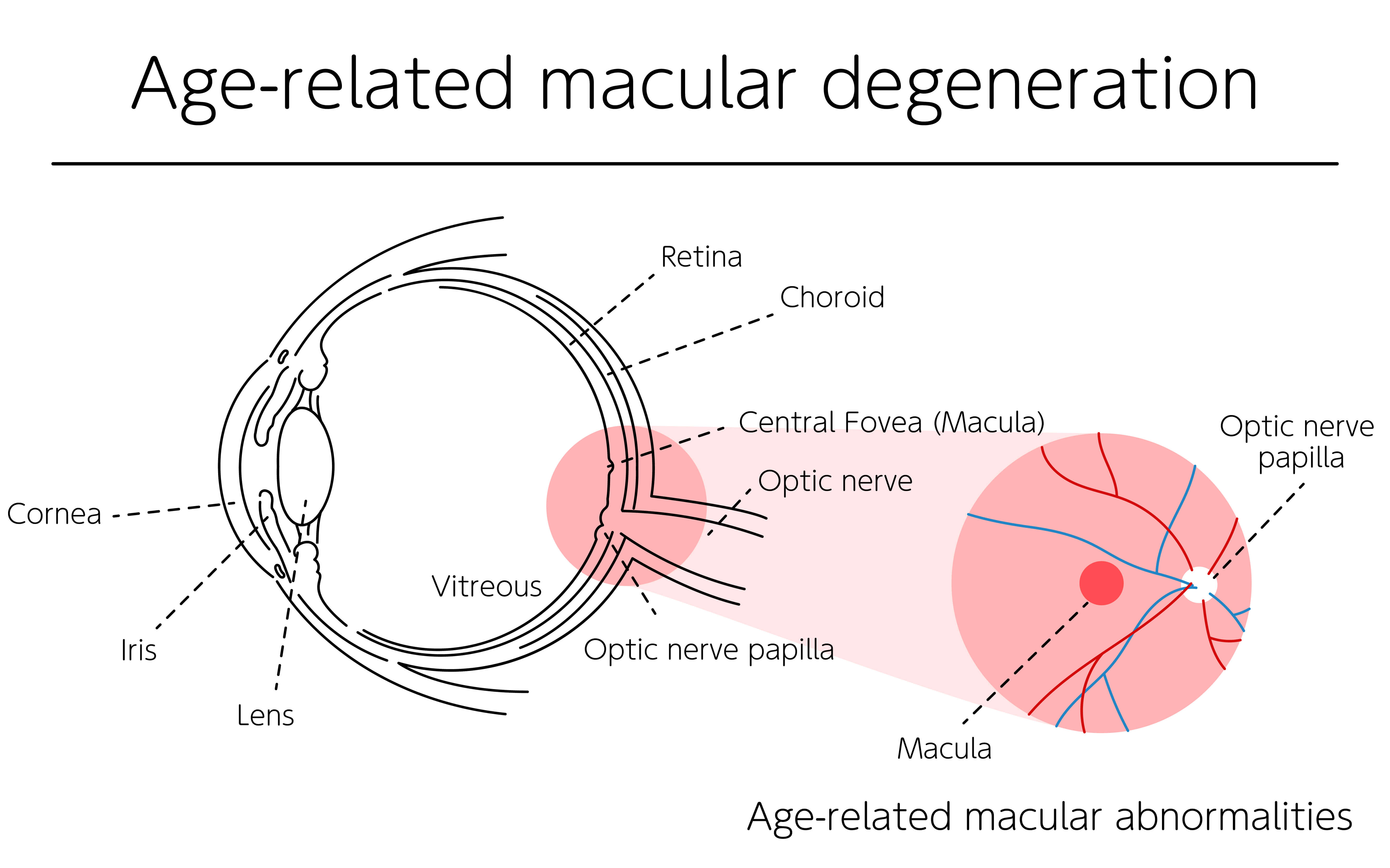 Age-related macular degeneration